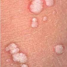 HPV AŞISI GENİTAL SİĞİLLERDEN KORUR MU?