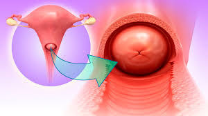 LEEP Ameliyatı Sık Sorulan Sorular