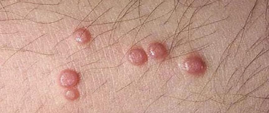 Genital Siğil Hakkında Sık Sorulan Sorular (SSS)