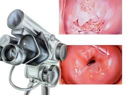 Anormal Pap Smear Sonuçlarında Kolposkopi Prof. Dr. Birol Vural Uzman Rehberi