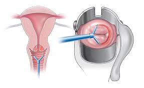 LEEP Ameliyatı Nedir?