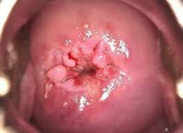 CIN1, CIN2, CIN3 Tedavisinde Lazer